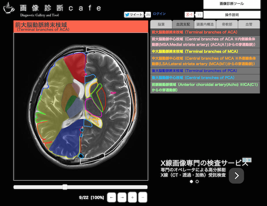 脳MRIの正常解剖図譜(横断像)